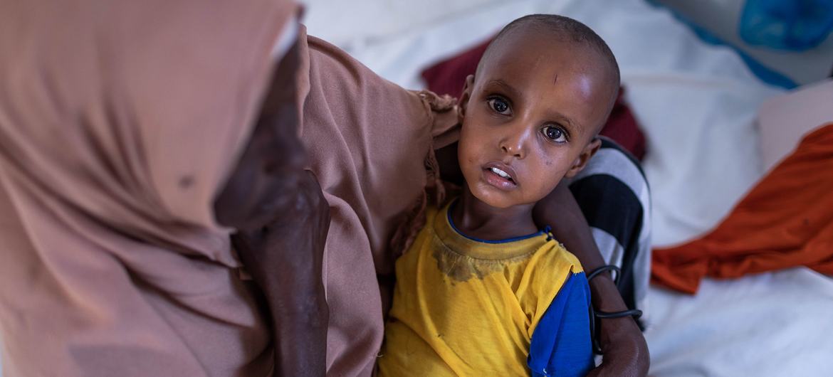 طفل يبلغ من العمر عامين يعالج من سوء التغذية الحاد في مستشفى في الصومال.