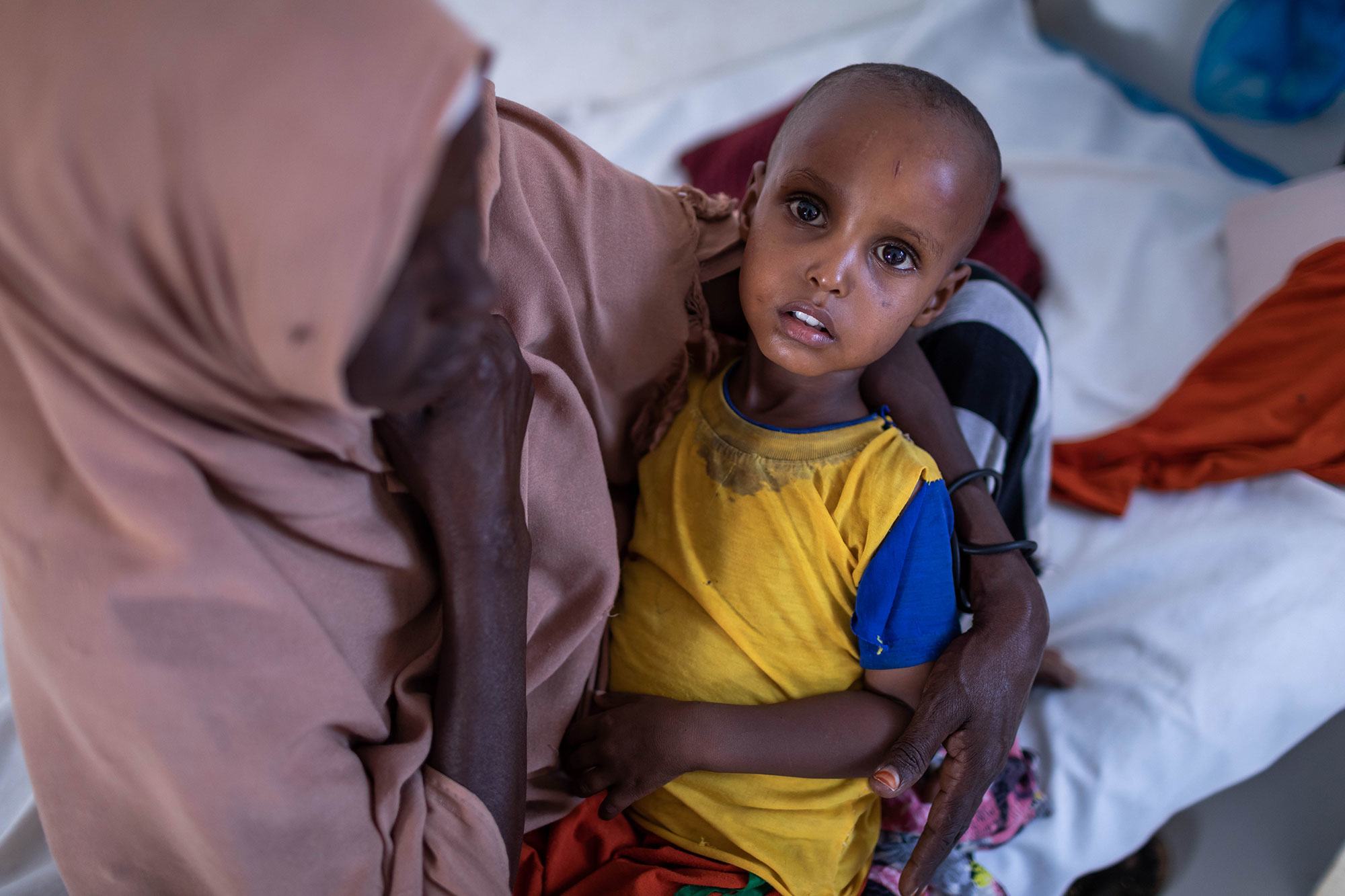 طفل يبلغ من العمر عامين يعالج من سوء التغذية الحاد في مستشفى في الصومال.