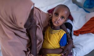  Un niño de dos años es tratado por desnutrición grave en un hospital de Somalilandia.