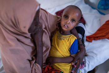  Un niño de dos años es tratado por desnutrición severa en un hospital de Somalilandia.