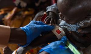Un enfant est examiné pour malnutrition dans un établissement de santé du camp d'Um Sagour, dans l'État du Nil Blanc au Soudan.