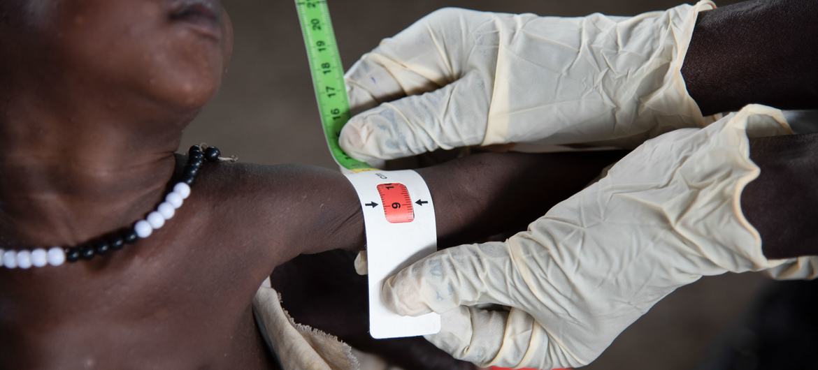 A nutrition worker measures the arm of a severely malnourished baby at a clinic in South Sudan.
