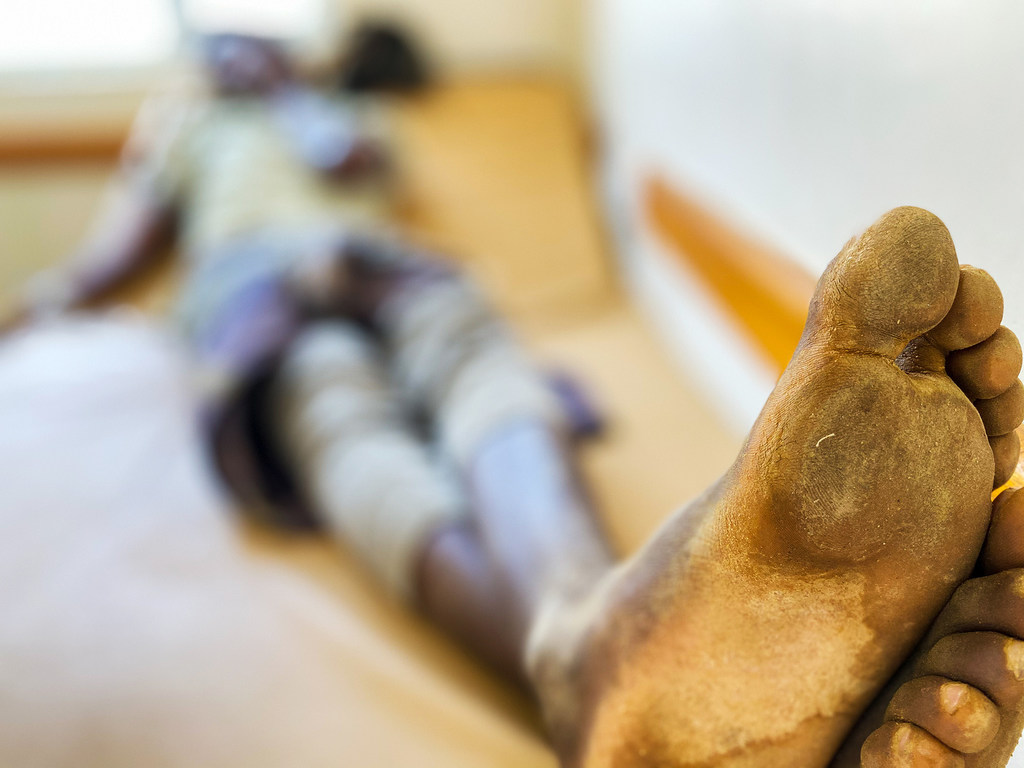 Un migrant se repose dans une clinique du nord du Yémen après un long et épuisant voyage