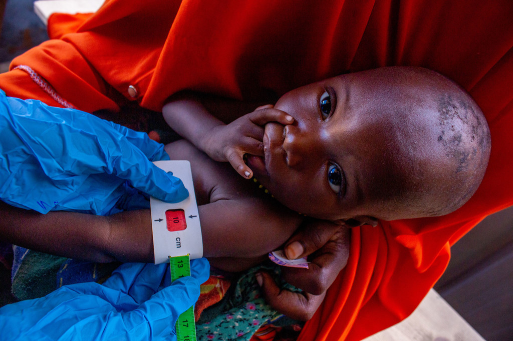 Le petit Ahmed Mohammed, âgé d'un an, subit un contrôle de la malnutrition sur un site du programme d'alimentation thérapeutique ambulatoire soutenu par des partenaires humanitaires dans l'État de Jubaland, en Somalie. 