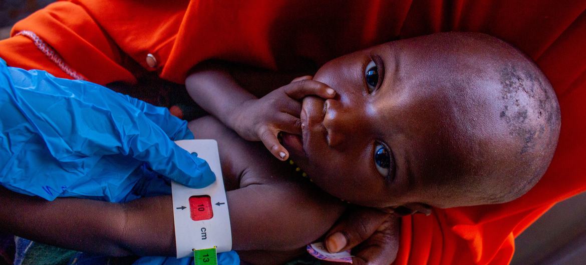 一岁的小艾哈迈德·穆罕默德在索马里朱巴兰州基斯马尤的人道主义合作伙伴支持下，在门诊治疗性喂养计划（OTP）接受营养不良检查。在该国许多地区，严重营养不良的情况依然存在。