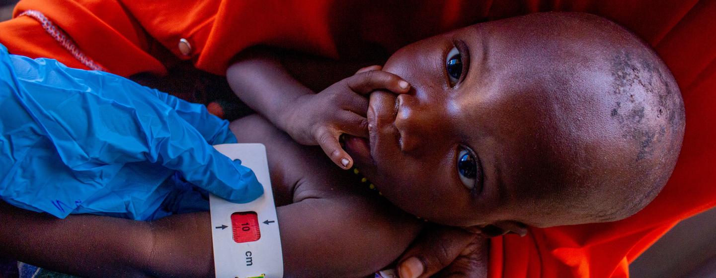 احمد محمد یک ساله تحت بررسی سوءتغذیه در یک سایت برنامه تغذیه درمانی سرپایی تحت حمایت شرکای بشردوستانه در ایالت جوبالند، سومالی قرار می گیرد، کشوری که تخمین زده می شود 1.8 میلیون کودک زیر پنج سال در آن به شدت مبتلا شوند.