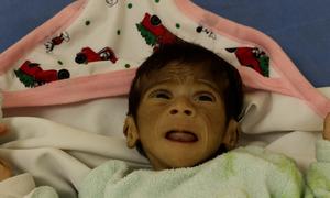 Un niño gravemente desnutrido en el hospital Abdel Aziz Al-Rantisi de la Franja de Gaza.