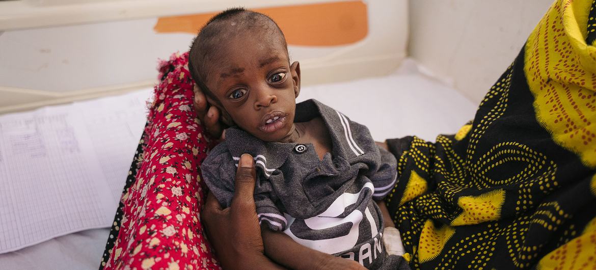Un garçon de dix mois est traité pour malnutrition sévère dans un hôpital du Puntland, en Somalie.