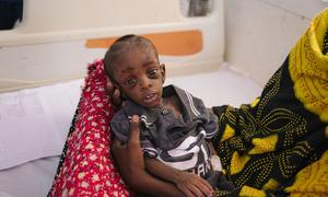  A ten-month-old boy is treated for severe malnutrition at a hospital in Puntland, Somalia.