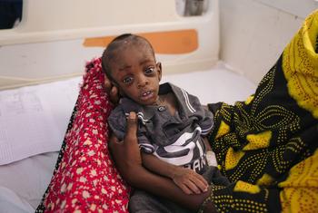  A ten-month-old boy is treated for severe malnutrition at a hospital in Puntland, Somalia.