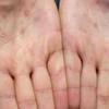 As lesões da varíola M geralmente aparecem nas palmas das mãos.