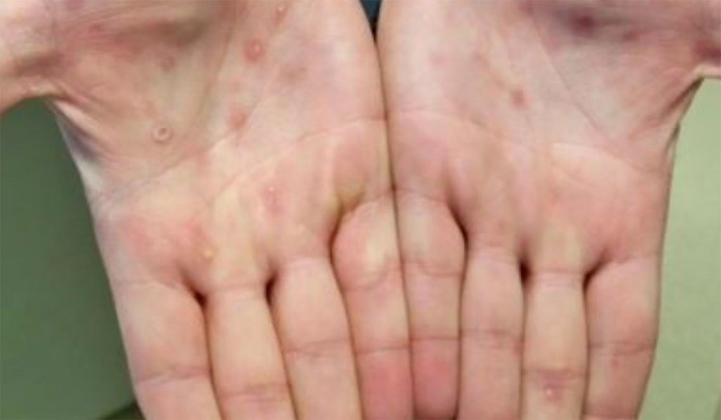 A patient's hands are shown with a rash and skin lesions from monkeypox.