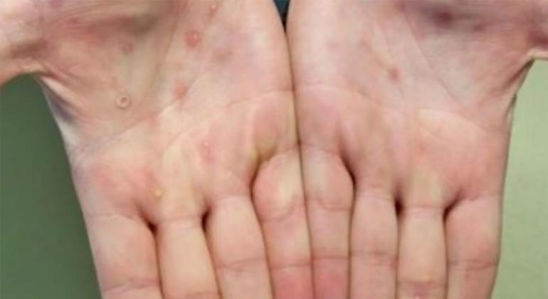 Monkeypox lesions often appear on the palms of the hands.