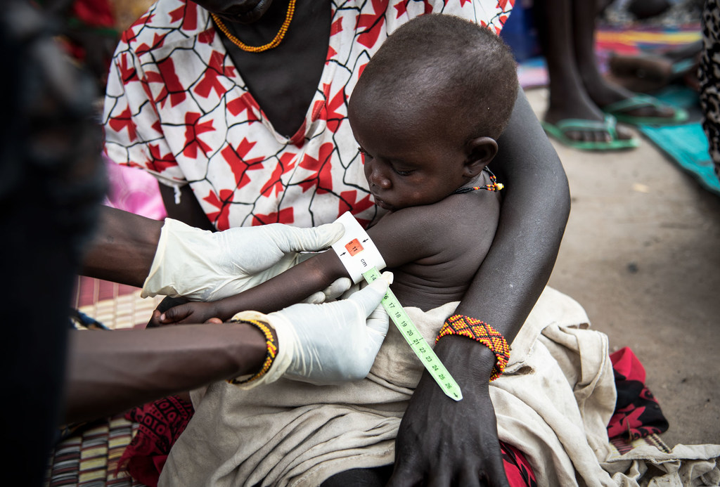 一名儿童正在南苏丹的一家诊所接受检查。 