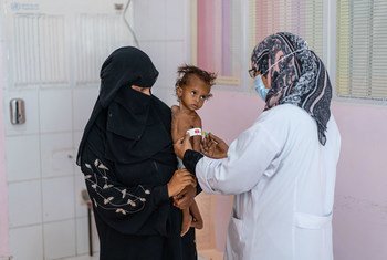 Criança de um ano e meio recebe tratamento para desnutrição no Iêmen. 