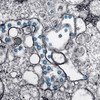 Una imagen microscópica muestra la infección del coronavirus (en azul) del primer paciente descubierto en Estados Unidos.