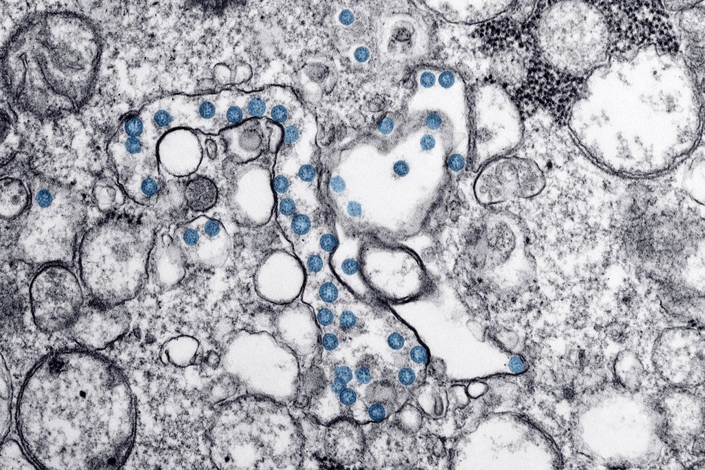 Une image microscopique améliorée numériquement montre une infection au coronavirus en bleu du premier cas découvert aux États-Unis.