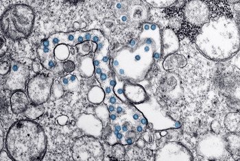 Una imagen microscópica muestra la infección del coronavirus (en azul) del primer paciente descubierto en Estados Unidos.