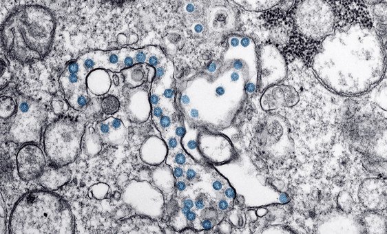 Imagem microscópica digitalmente aprimorada mostra uma infecção por coronavírus em azul.