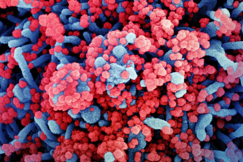 从一名患者体内采集的细胞染色照片显示出蓝色的细胞受到红色新冠病毒的严重感染。