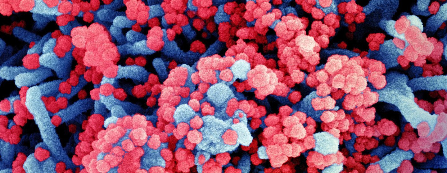 Micrographie électronique à balayage colorisée d'une cellule (bleu) fortement infectée par des particules virales du SRAS-CoV-2 (rouge).