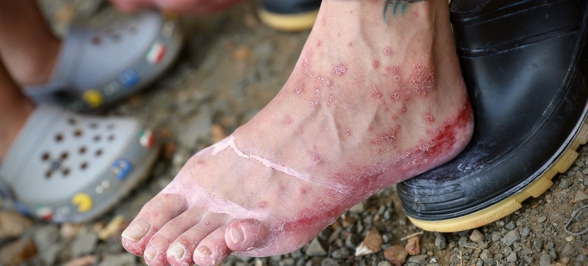 A migrant arrives in Lajas Blancas, Panama, with blood blistered feet.