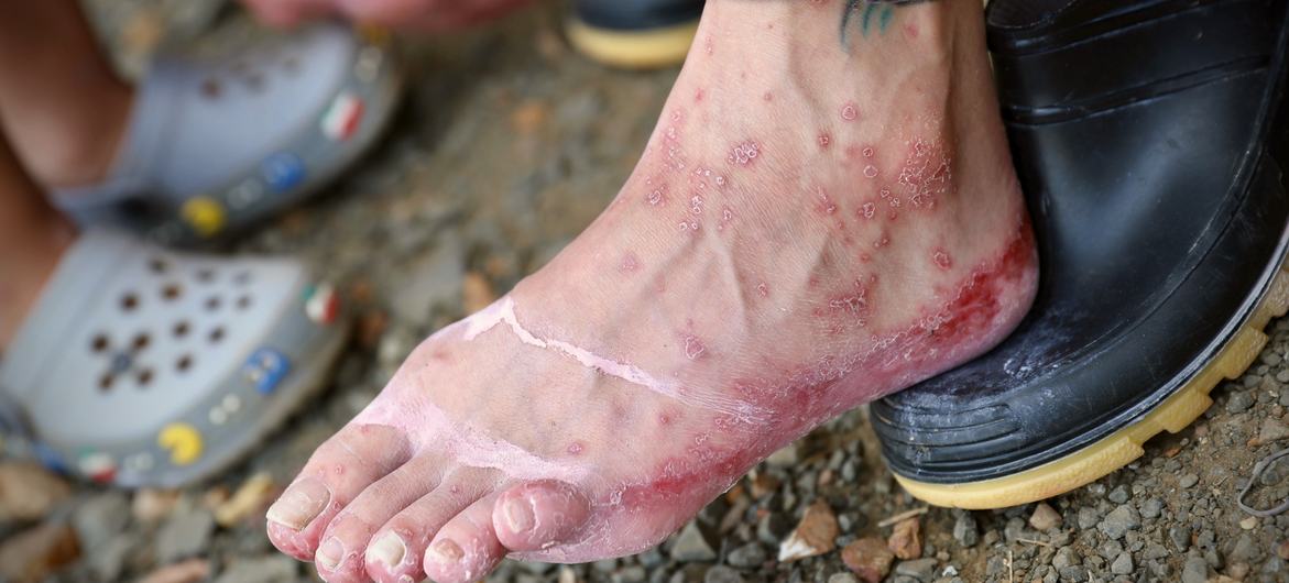 Un migrante llegó a Lajas Blancas, Panamá, con los pies llenos de sangre.