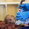 Un médico mide la circunferencia del brazo de Ibrahim, un niño de ocho meses que sufre desnutrición, en un hospital de Mogadiscio (Somalia).