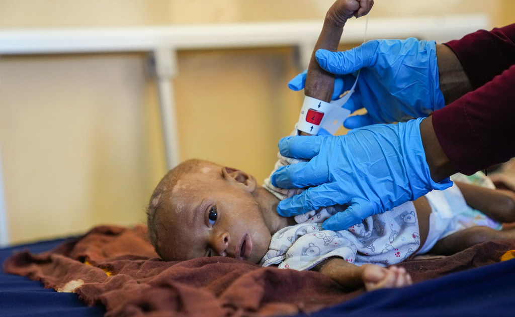Ibrahim mtoto wa miezi 8 anayeugua utapiamlo akifanyiwa vipimo katika hospitali ya Moghadishu Somalia