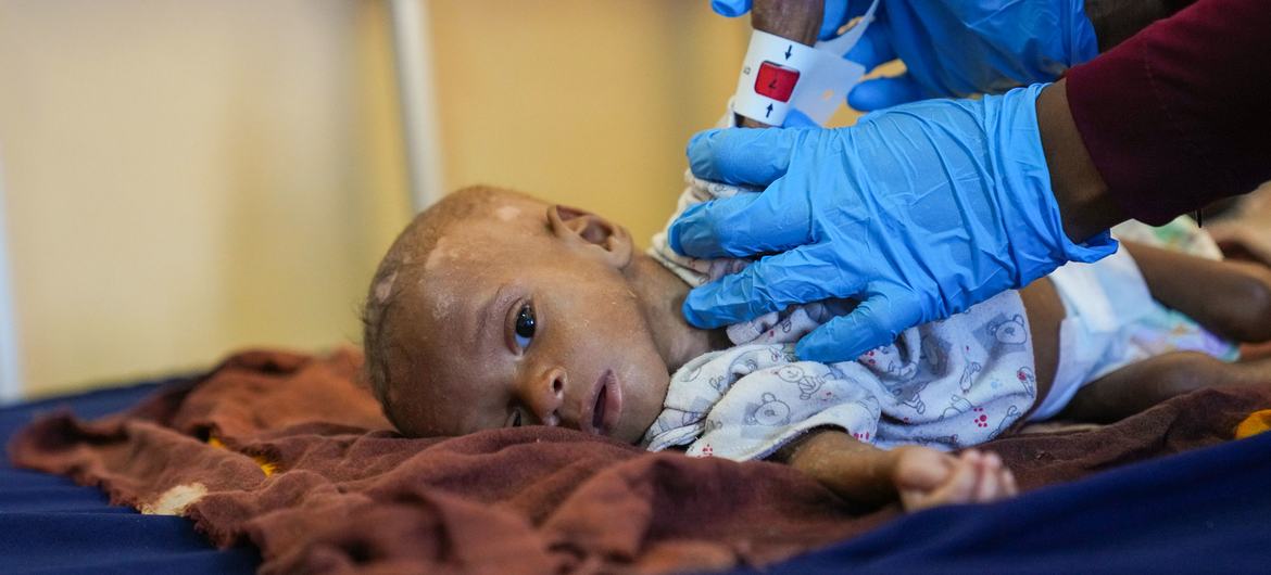 八个月大的易卜拉欣营养不良，在索马里首都摩加迪沙的一家医院里，医生正在测量他的臂围。