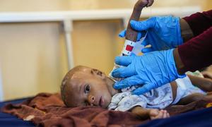 Ibrahim, âgé de huit mois et souffrant de malnutrition, se fait mesurer la circonférence de son bras par un médecin dans un hôpital de Mogadiscio, en Somalie.