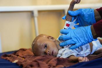Eight-month-old Ibrahim, who is suffering from malnutrition, has his arm circumference measured by a doctor at a hospital in Mogadishu, Somalia.