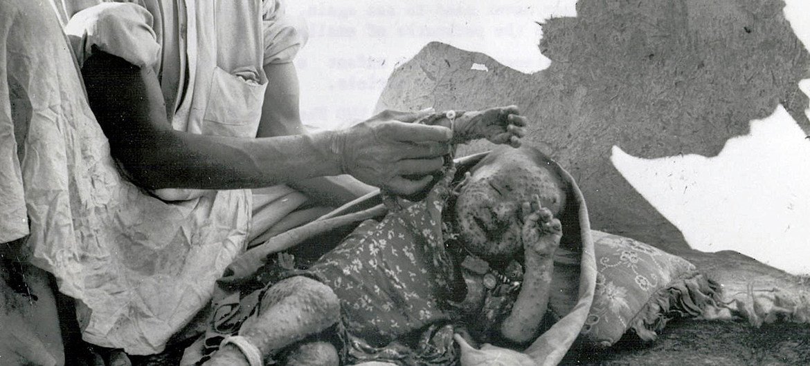 A vision that the world will never see again. This baby survived, but the scars that smallpox left will mark him for the rest of his life.