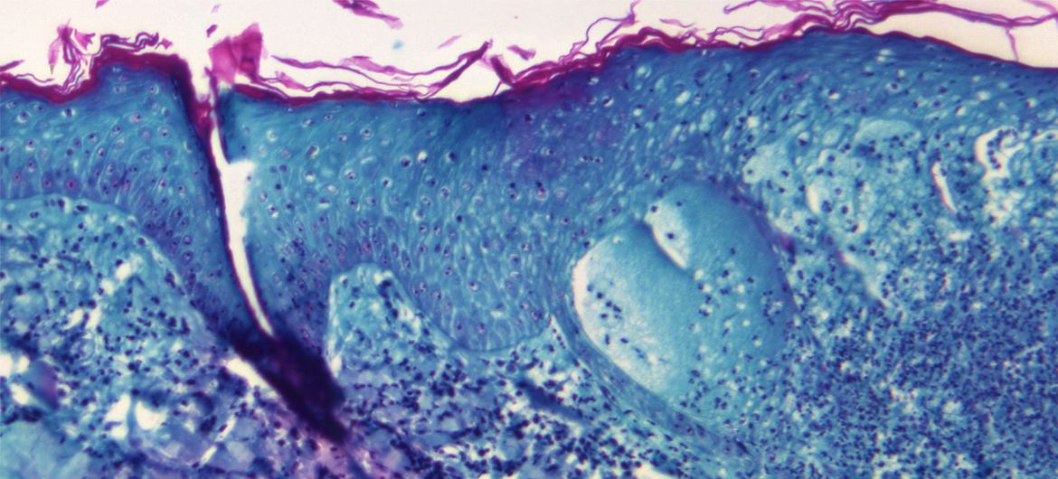 Image agrandie d'une lésion de la peau d'un singe infecté par le virus de la variole du singe.