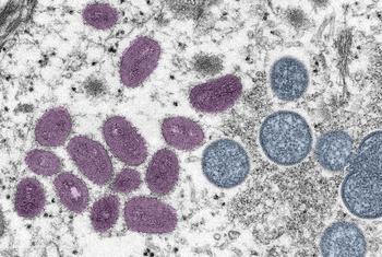 Monkeypox ugonjwa nadra lakini hatari sawa na virusi vya ndui ambayo sasa imetokomezwa.