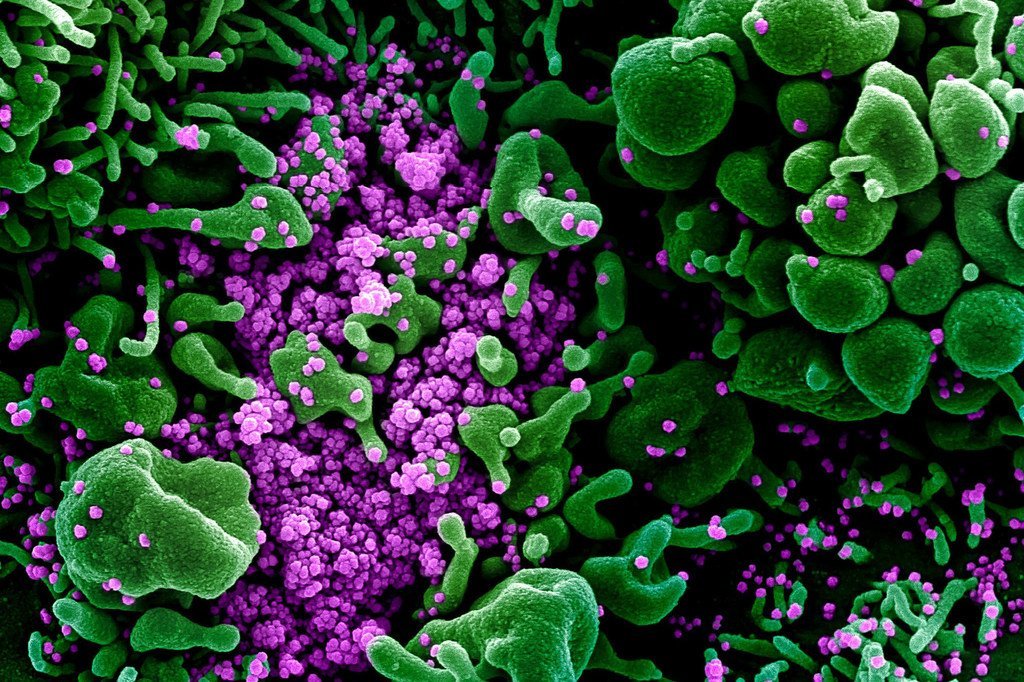 Una imagen digitalmente aumentada de una muestra de un paciente presenta células verdes muy infectadas con la partícula de virus SARS-COV-2 de color púrpura.
