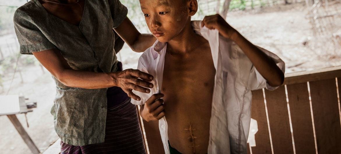طفل أصيب بانفجار ذخيرة غير منفجرة في ولاية كايين، ميانمار.