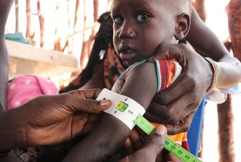 Un enfant malnutri est évalué dans une clinique au Soudan du Sud.