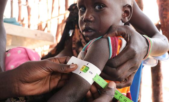 A malnourished child is assessed at a nutrition clinic in Fangak county, South Sudan.