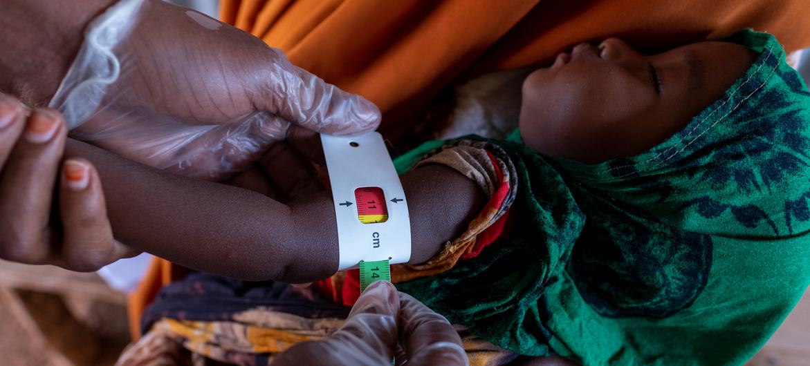 يجري فحص طفل يبلغ من العمر 7 أشهر لمعرفة ما إذا كان يعاني من سوء التغذية بسبب الجفاف الشديد في المنطقة بالصومال