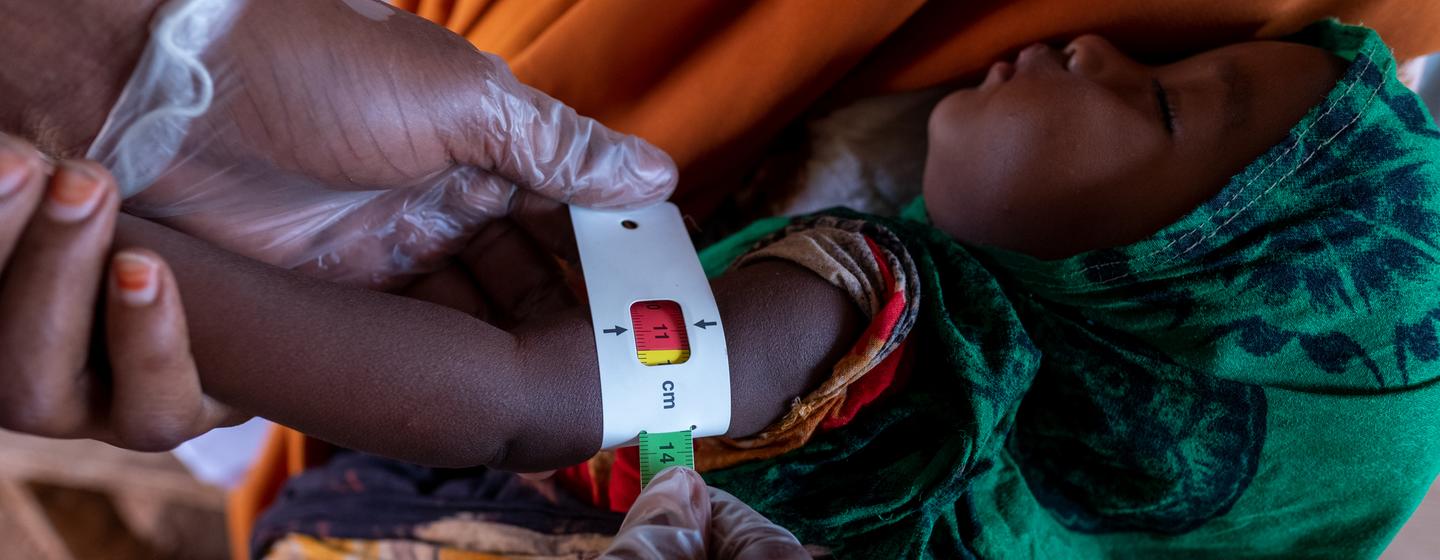 Un enfant est examiné dans une clinique de l'UNICEF à Dollow, en Somalie, pour évaluer l'étendue de la malnutrition.