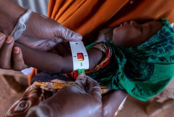 由于索马里的严重干旱，一名七个月大的婴儿正在接受营养不良检查。