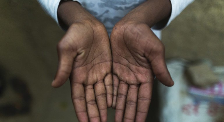 The hands of a survivor who was rescued from a bangle making factory in Hyderabad, India in 2015. 