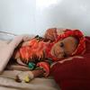 An 18-month-old  in Afghanistan suffers from severe acute malnutrition with medical complications. 