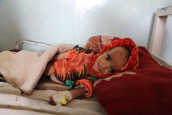 An 18-month-old  in Afghanistan suffers from severe acute malnutrition with medical complications. 