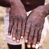 A young man shows his hands during an outbreak of monkeypox in the Democratic Republic of the Congo. (file)
