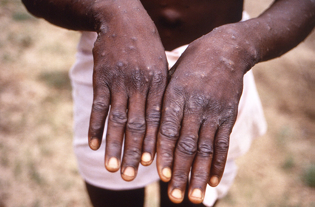 A young man shows his hands during an outbreak of monkeypox in the Democratic Republic of the Congo (file photo).