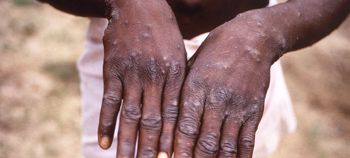 在刚果民主共和国暴发猴痘期间，一名年轻人展示他的双手。(档案照片)