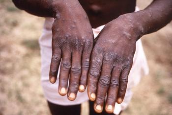 Um jovem mostra as mãos durante um surto de varíola dos macacos na República Democrática do Congo