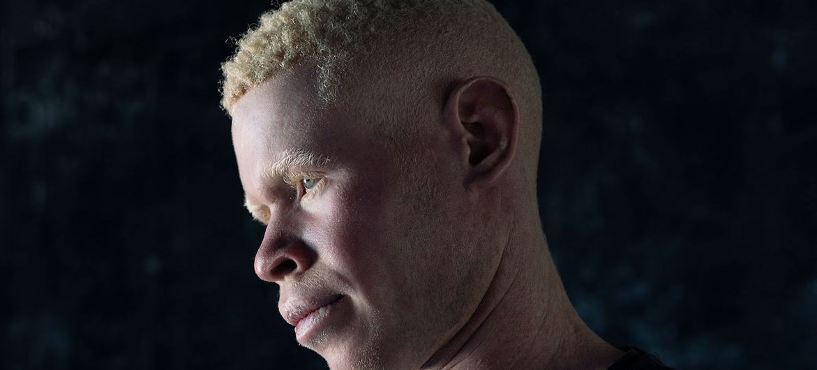 Charles, 16, morava com a mãe e o pai na RD Congo. Sua família foi forçada a fugir porque ele foi perseguido por ser albino